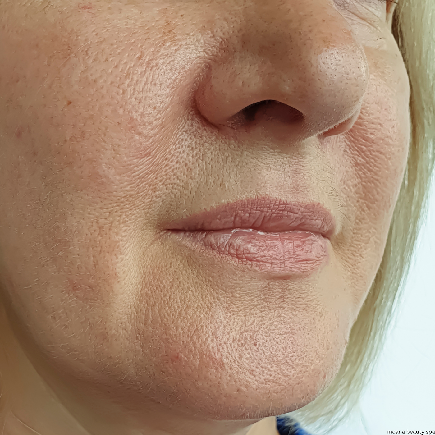 Wrinkle Appearance — before