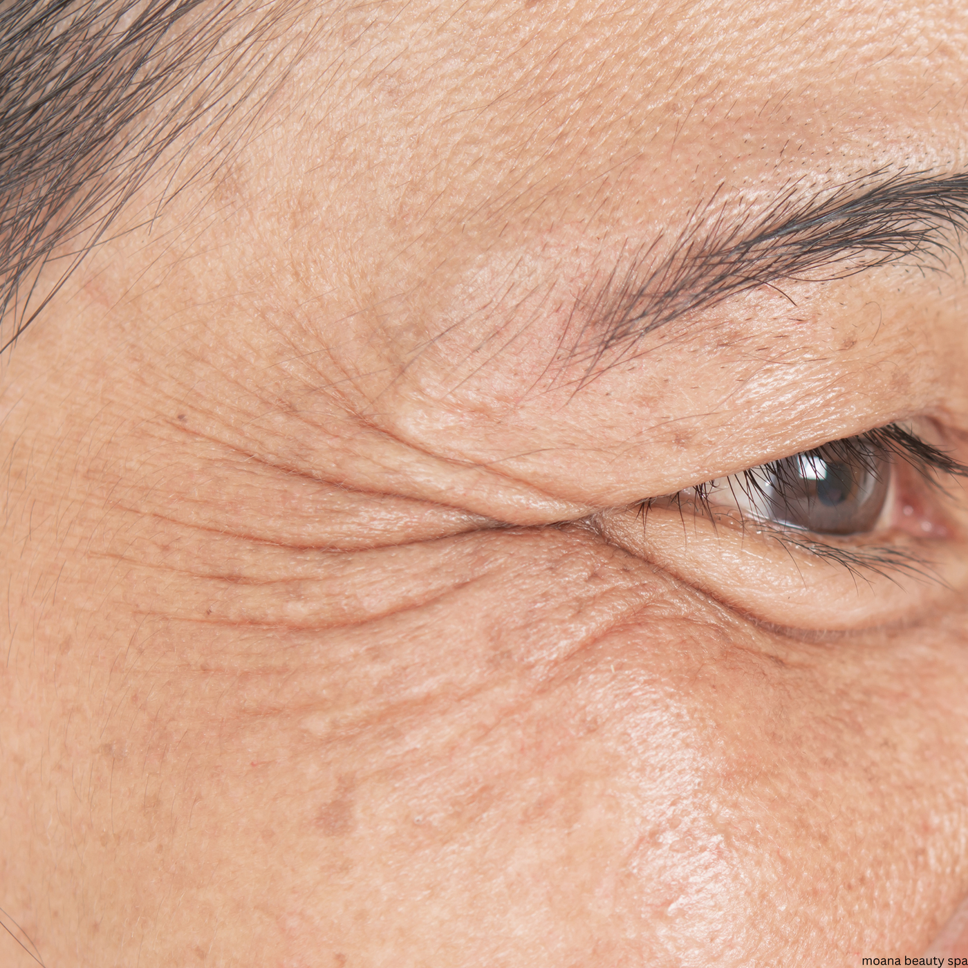 Eye Area Appearance — before