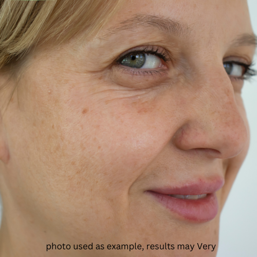 Eneo Non-Surgical Facelift — Before