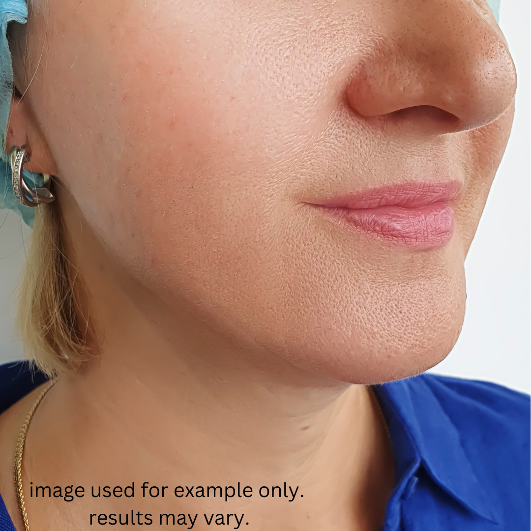 Lumen LED Radiance Therapy — After